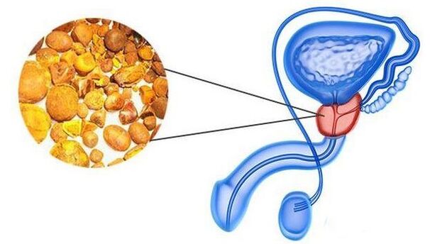 Calkinonon in the prostate gland