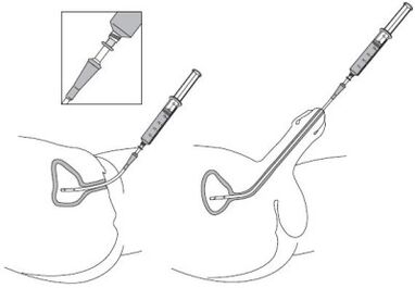 Instillation of a solution for medicines in the urethra