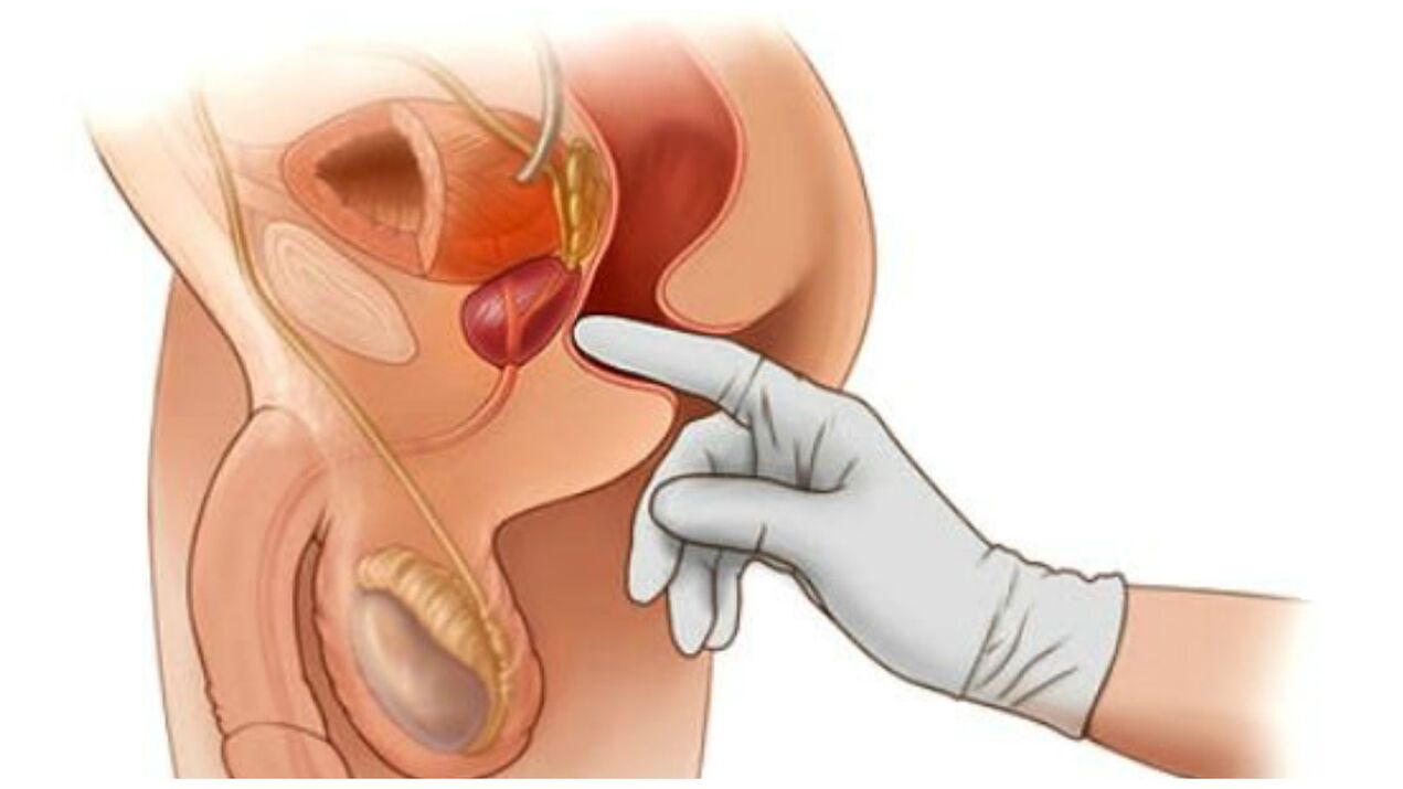 Prostate massage for chronic prostatitis