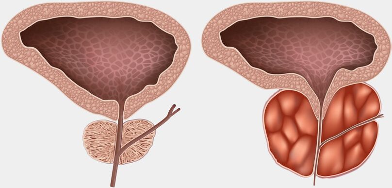 healthy and inflamed prostate with prostatitis