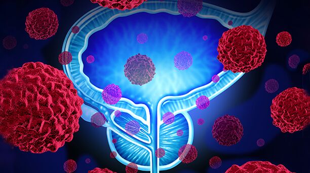 bacteria as a cause of prostatitis