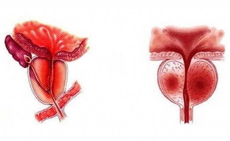 Acute inflammation of the prostate gland, which can become chronic