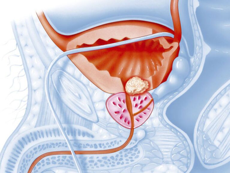 In chronic prostatitis, the lumen of the urethra narrows, which makes it difficult to pass urine. 